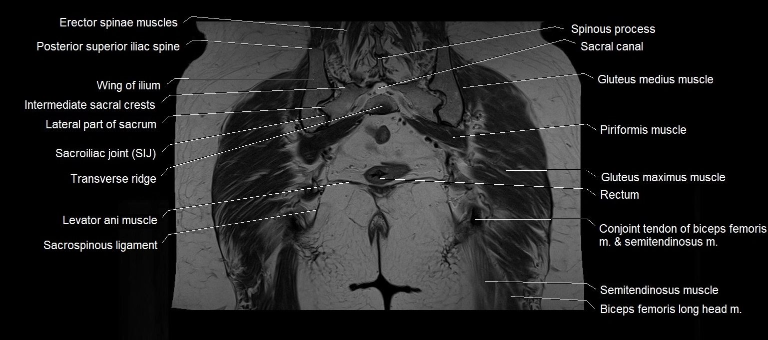 MRI 3T pelvis coronal cross section anatomy image 21.webp